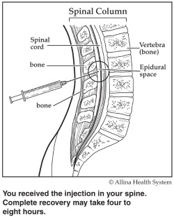 spinal column/epidural diagram