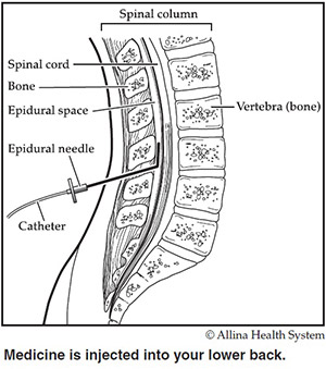 Epidural Chart