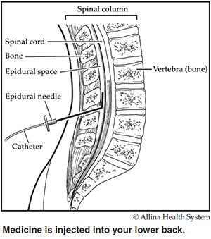 During an epidural, medicine is injected into your lower back.