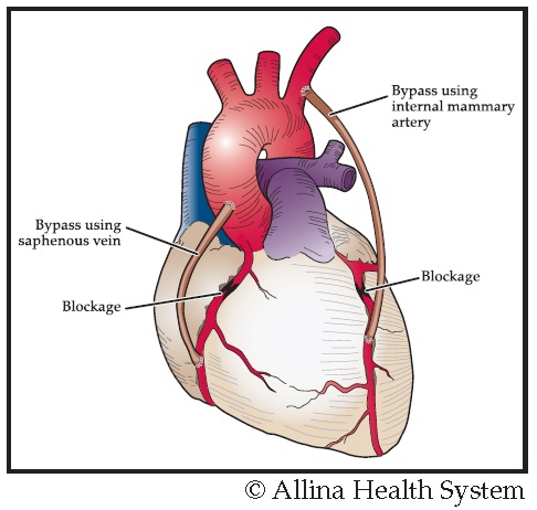 This graphic of the heart shows two blockages and a bypass using a saphenous vein and another bypass using an internal mammary artery
