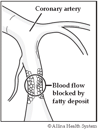 atherosclerosis illustration