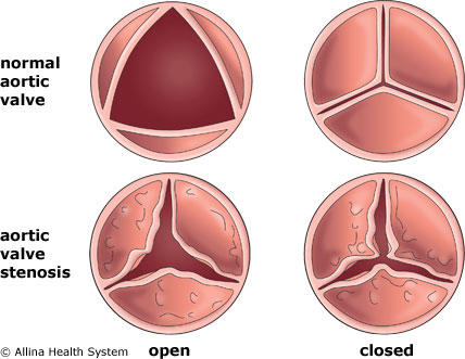 Diagram compares a normal aortic valve to a heart valve with aortic stenosis