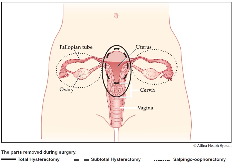 illustration of types of hysterectomy surgeries