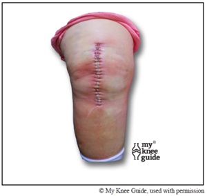 Knee incision redness