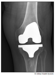 Xray total knee replacement