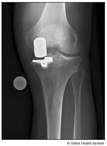 Xray partial knee replacement