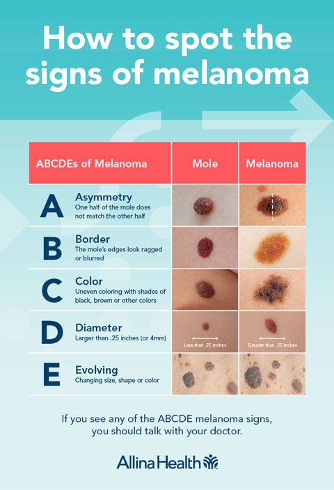Infographic explaining the melanoma ABCDE acronym and providing visual examples of each sign of melanoma.