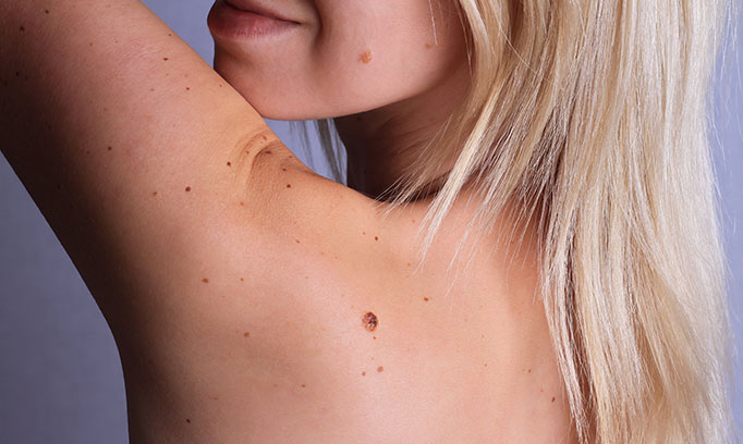 Woman looking over her shoulder at a mole on her back trying to see if there are signs of melanoma