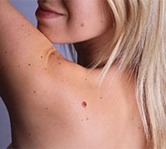 melanoma april care 214x192