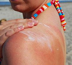 sunburn istock 9673045 214x192