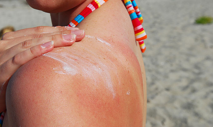 A person on the beach applying sunscreen to their shoulder to avoid getting a sunburn