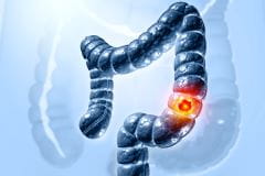 colon cancer