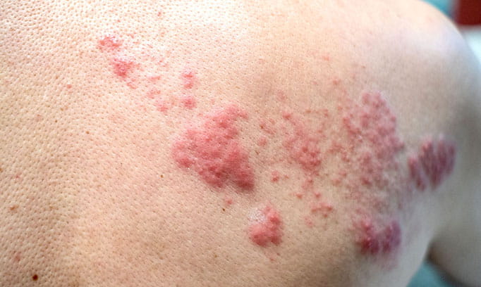 shingles on back, what shingle looks like