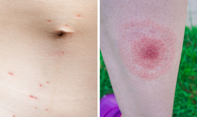 Two examples of tick bites, one partially burrowed into the skin and the other fully burrowed with a circular rash.