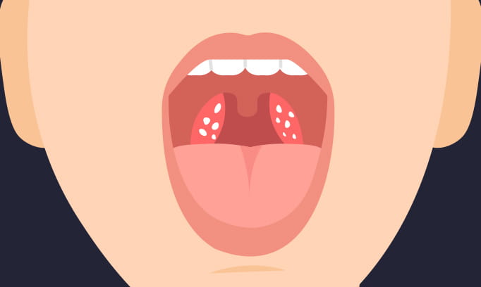 Tonsil stones illustration what do tonsil stones look like